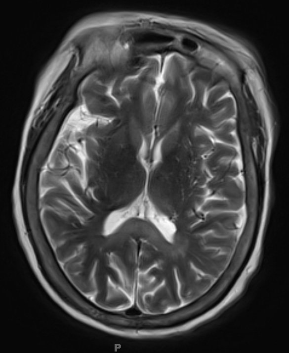 1A3 Alcoholic Encephalopathy - Marchiafava-Bignami (Case 1) T2 W1 - Copy