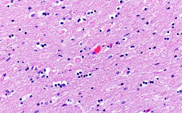 1C10 Marchiafava-Bignami (Case 1, N19) H&E 2