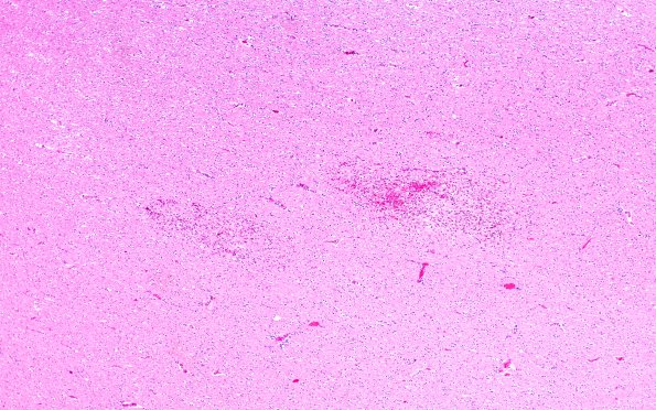 1C2 Alcoholic encephalopathy, Marchiafava-Bignami,  (Case 1) H&E 1