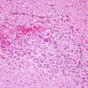 1C3 Alcoholic encephalopathy, Marchiafava-Bignami, no MB (Case 1) N14 H&E 6