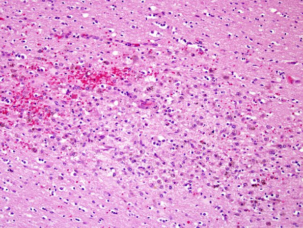 1C3 Alcoholic encephalopathy, Marchiafava-Bignami, no MB (Case 1) N14 H&E 6