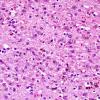 1C4 Alcoholic encephalopathy, Marchiafava-Bignami, no MB (Case 1) N14 H&E 5