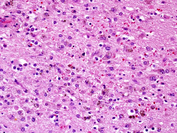 1C4 Alcoholic encephalopathy, Marchiafava-Bignami, no MB (Case 1) N14 H&E 5