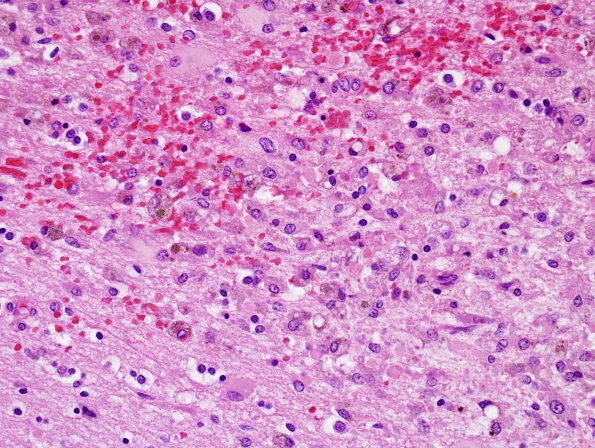 1C5 Alcoholic encephalopathy, Marchiafava-Bignami, no MB (Case 1) N14 H&E 