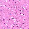 1C6 Alcoholic encephalopathy, Marchiafava-Bignami,  (Case 1) H&E area A 40X copy