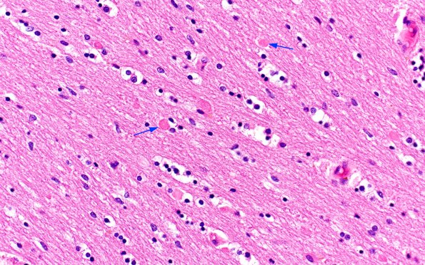 1C6 Alcoholic encephalopathy, Marchiafava-Bignami,  (Case 1) H&E area A 40X copy