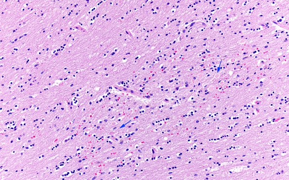 1C9 Marchiafava-Bignami (Case 1, N19) H&E 3 copy