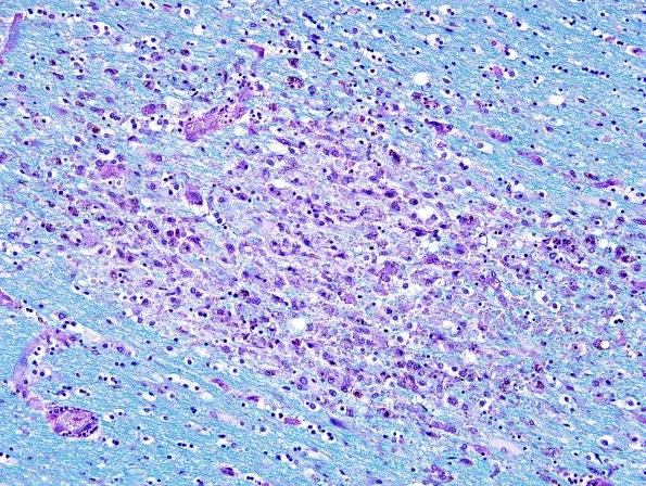 1D Alcoholic encephalopathy, Marchiafava-Bignami, no MB (Case 1) LFB-PAS A1