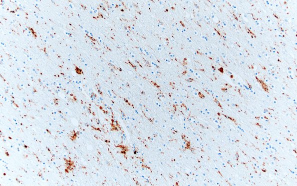 1F3 Alcoholic encephalopathy, Marchiafava-Bignami,  (Case 1) CD68 1