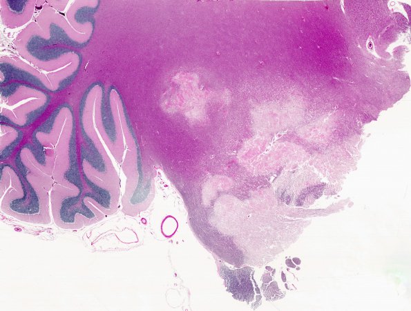 2A1 Marchiafava-Bignami Disease 1 (CANP 2004 Case 3) H&E whole mount