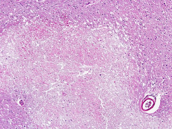 2A2 Marchiafava-Bignami Disease (CANP 2004 Case 3) H&E 2