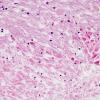 2A5 Marchiafava-Bignami Disease (CANP 2004 Case 3) H&E 4