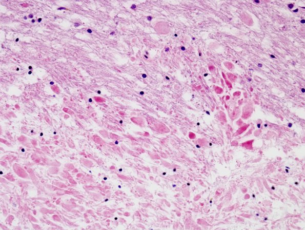 2A5 Marchiafava-Bignami Disease (CANP 2004 Case 3) H&E 4