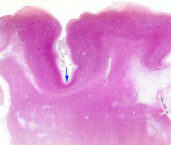 1A1 Alpha- fucosidosis (AANP 1996, Case 3) H&E whole mount copy