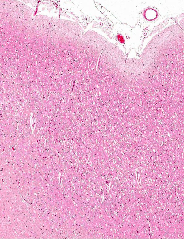 1A2 a-Fucosidosis (AANP 1996, Case 3) H&E X4 1