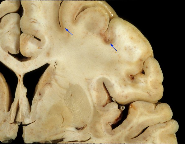 1A3 Hypoglycemia, chronic (Case 1) 6 copy