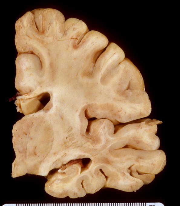 1A6 Hypoglycemia, chronic (Case 1) 3A