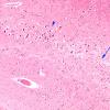 1B5 Hypoglycemia, chronic (Case 1) H&E N3B 10X CA1-2,3 copy