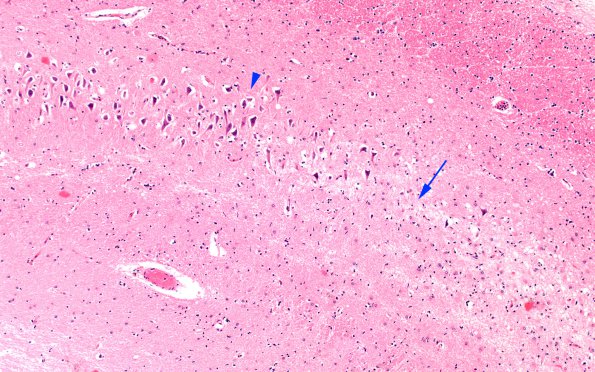 1B5 Hypoglycemia, chronic (Case 1) H&E N3B 10X CA1-2,3 copy