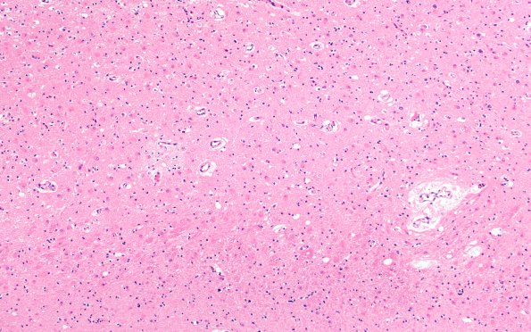 1B6 Hypoglycemia, chronic (Case 1) H&E N3B 10X subiculum