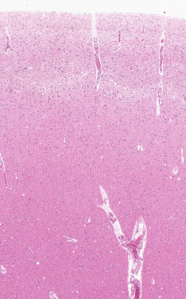 1C2 Hypoglycemia, chronic (Case 1) H&E N1A 4X