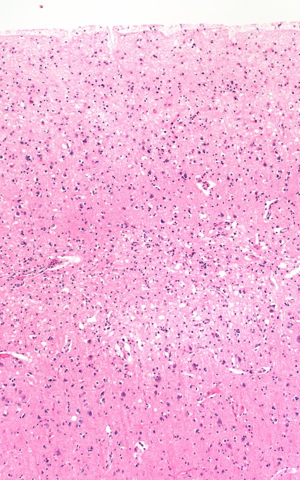 1C3 Hypoglycemia, chronic (Case 1) H&E N1A 10X