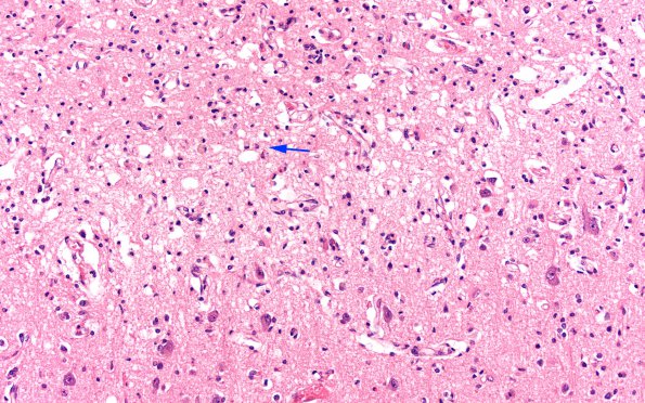 1C4 Hypoglycemia, chronic (Case 1) H&E N1A 20X copy