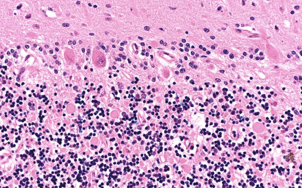 1D3 Hypoglycemia, chronic (Case 1) H&E N9 40X 2