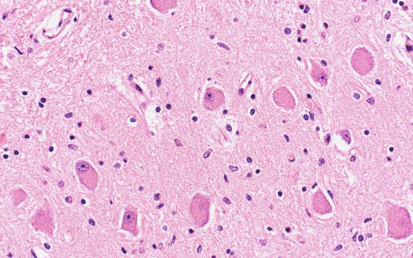1D5 Hypoglycemia, chronic (Case 1) H&E N9 40X dentate