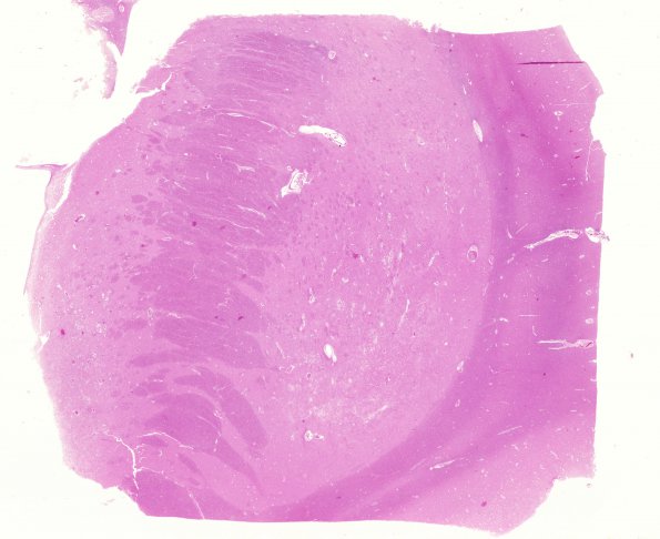 1E1 Hypoglycemia, chronic (Case 1) H&E N2B whole mount