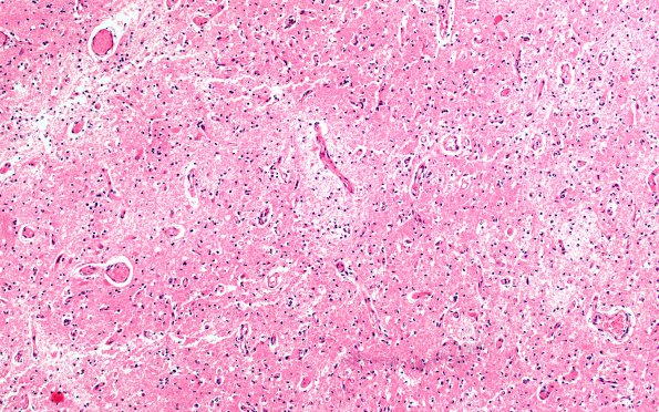 1E2 Hypoglycemia, chronic (Case 1) H&E N2B 10X