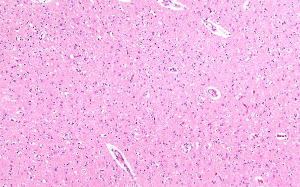 1F Hypoglycemia, chronic, thalamus (Case 1) H&E N4 10X