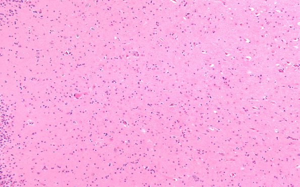2B2 Hypoglycemia (Case 2) H&E N3 CA4 10X