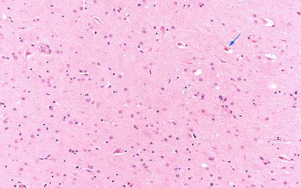 2B3 Hypoglycemia (Case 2) H&E N3 CA4 20X copy