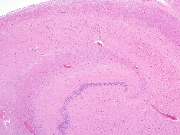 2B4 Hypoglycemic Coma (Case 2) N3 Hippocampus H&E 1