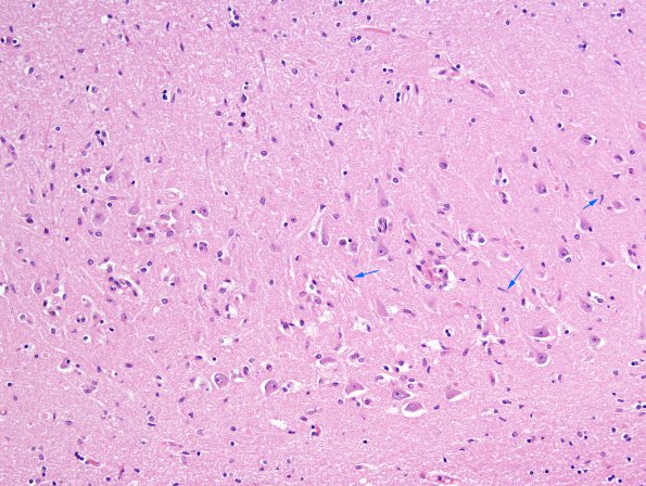 2B6 Hypoglycemic Coma (Case 2) N3 CA2 copy