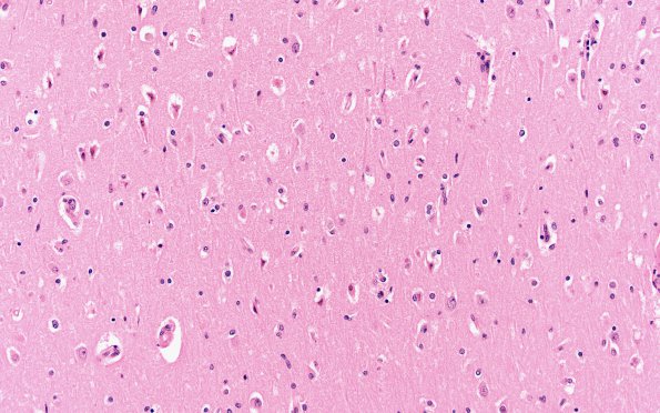 2B7 Hypoglycemia (Case 2) H&E N3 CA1 20X