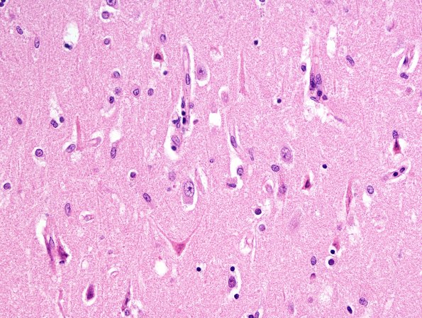 2B8 Hypoglycemic Coma (Case 2) N3 CA1 1