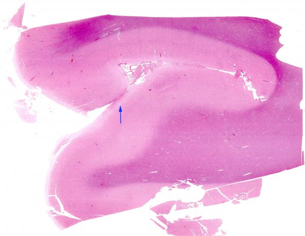 2C1 Hypoglycemic Coma (Case 2) N1 H&E whole mount copy