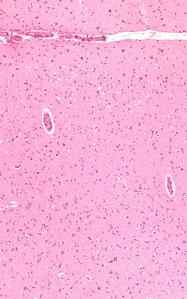 2C2 Hypoglycemia (Case 2) H&E N1 10X