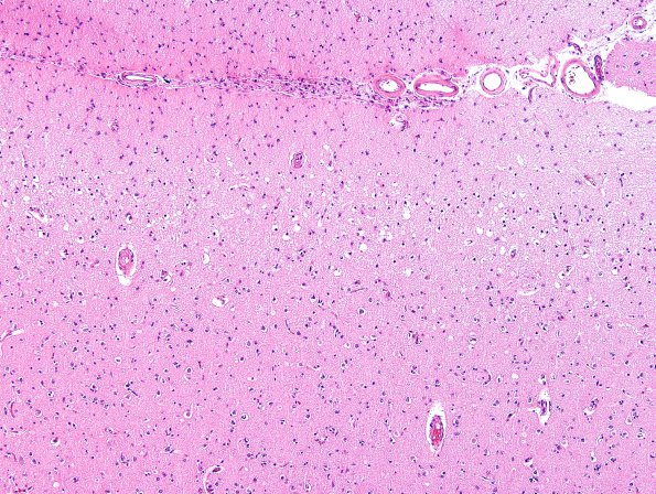 2C3 Hypoglycemic Coma (Case 2) N1 H&E 1
