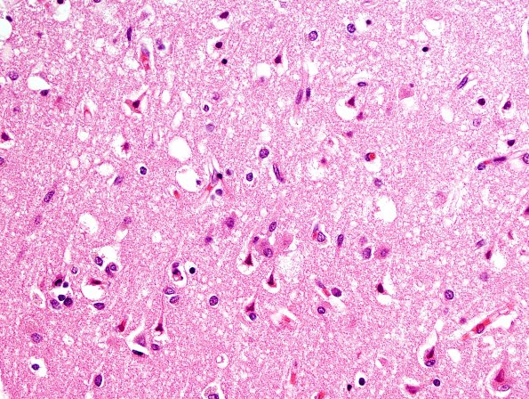 2C4 Hypoglycemic Coma (Case 2) N1 H&E 5