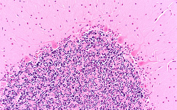 2D3 Hypoglycemia (Case 2) H&E N9 20X