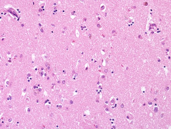 2E1 Hypoglycemic Coma (Case 2) N2 putamen H&E 1