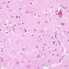 2E2 Hypoglycemic Coma (Case 2) N2 putamen H&E 2