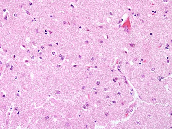 2E2 Hypoglycemic Coma (Case 2) N2 putamen H&E 2