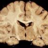 3A1 Hypoglycemic Encephalopathy (Case 3) 4 (2)