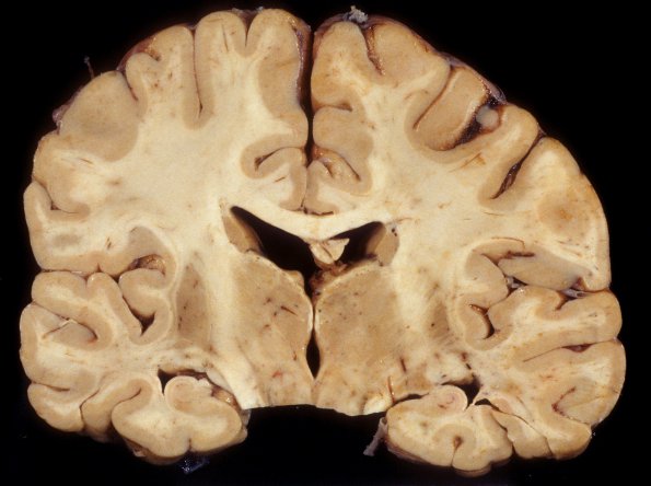 3A1 Hypoglycemic Encephalopathy (Case 3) 4 (2)