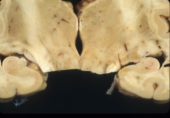 3A2 Hypoglycemic Encephalopathy (Case 3) 5 (2)