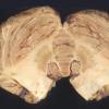 3A4 Hypoglycemic Encephalopathy (Case 3) A3